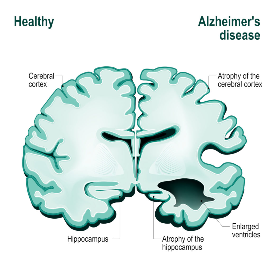 Alzheimer’s Disease A Deep Dive Into The Brain S Decline