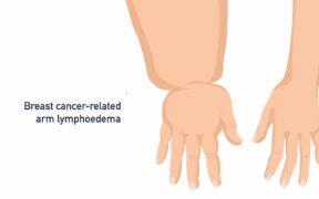 lymphoedema